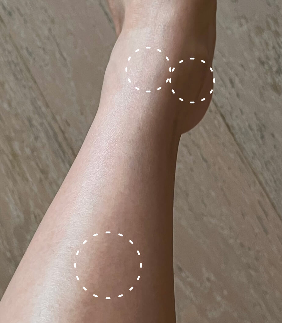 Image of a person's legs, all of their bug bites have healed